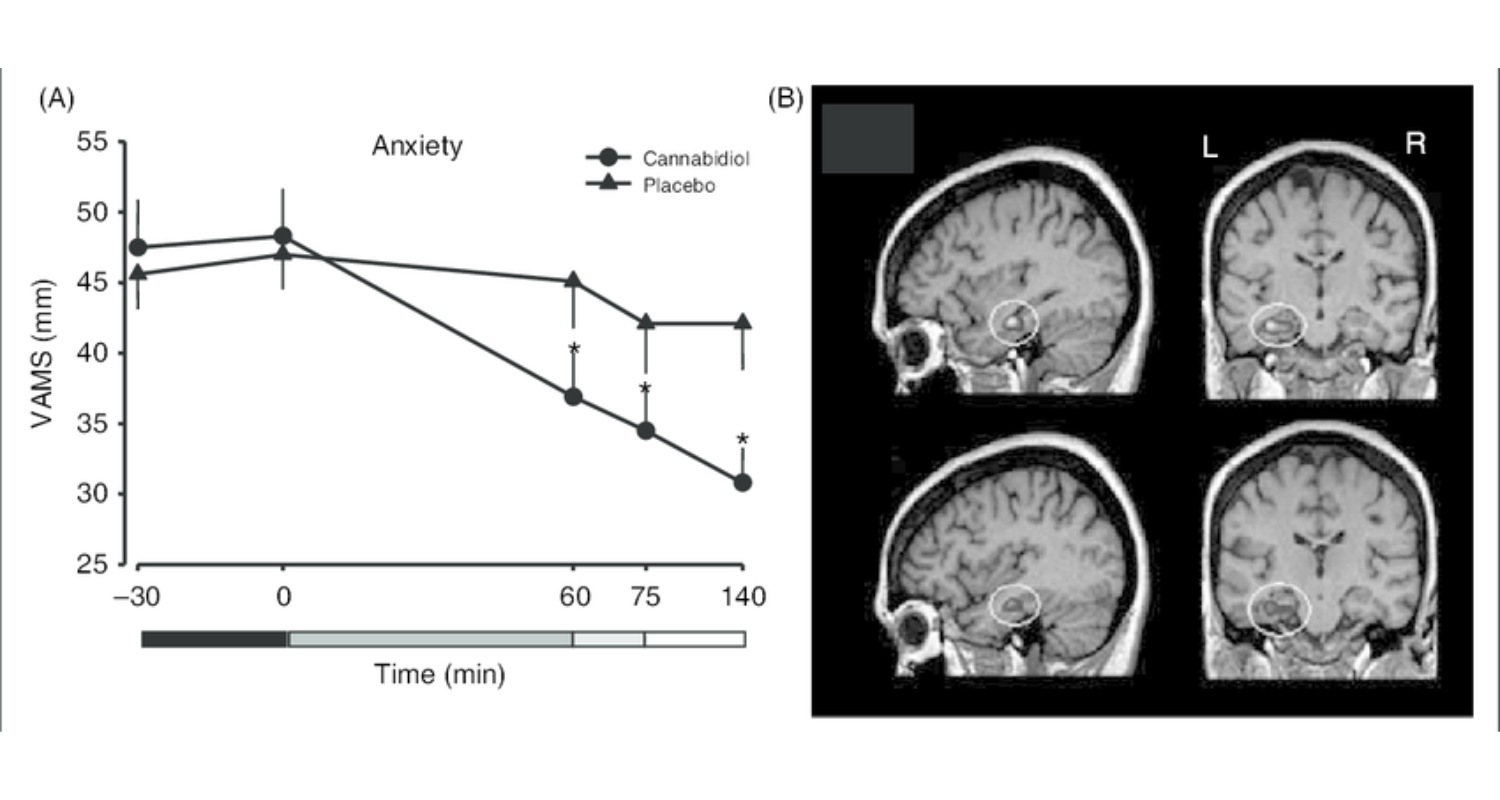 CBD for anxiety